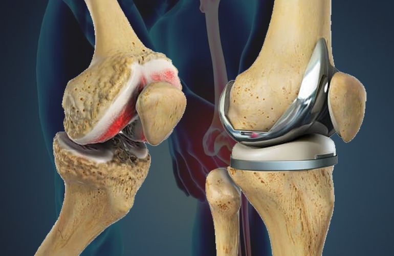 Knee Replacement Surgery Success Rate – A Guide for Kenyan…
